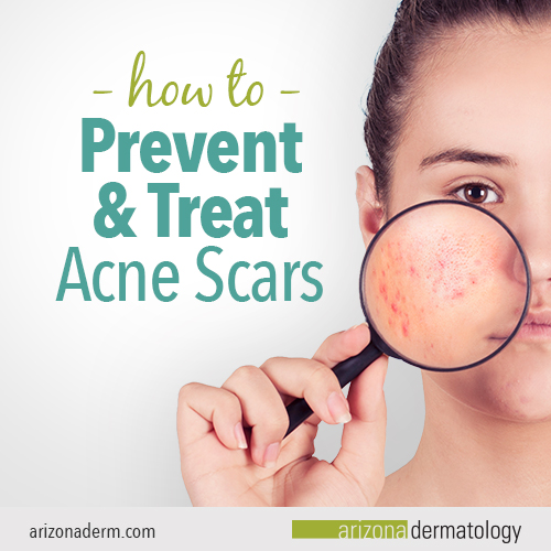 How To Treat And Prevent Acne